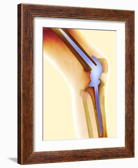 Knee Replacement, X-ray-Science Photo Library-Framed Photographic Print