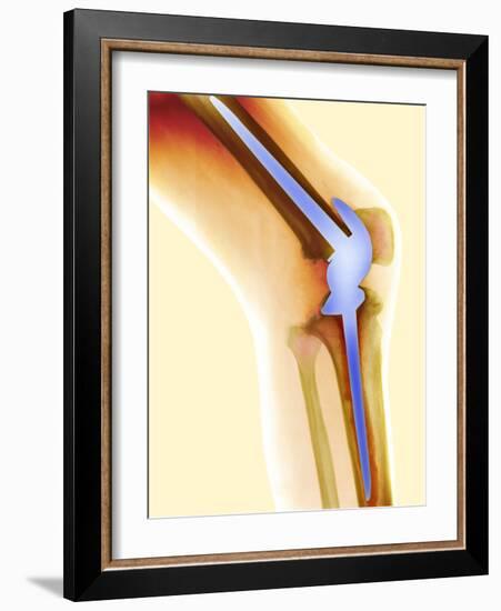 Knee Replacement, X-ray-Science Photo Library-Framed Photographic Print