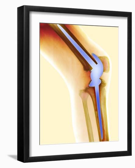 Knee Replacement, X-ray-Science Photo Library-Framed Photographic Print