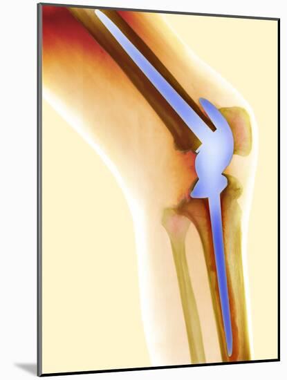Knee Replacement, X-ray-Science Photo Library-Mounted Photographic Print