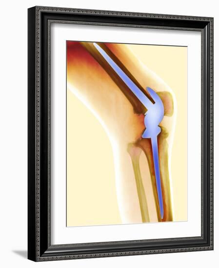 Knee Replacement, X-ray-Science Photo Library-Framed Photographic Print