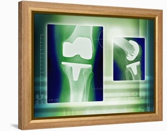 Knee Replacement, X-rays-Miriam Maslo-Framed Premier Image Canvas