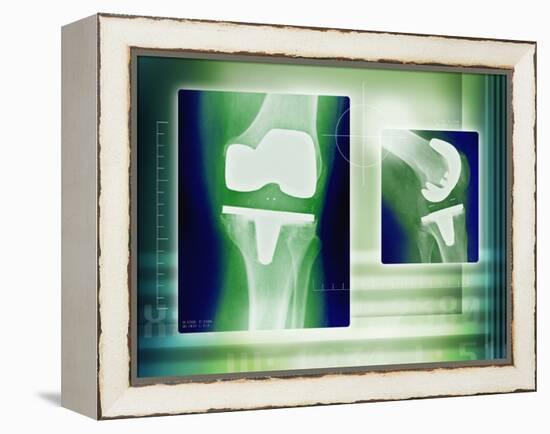 Knee Replacement, X-rays-Miriam Maslo-Framed Premier Image Canvas