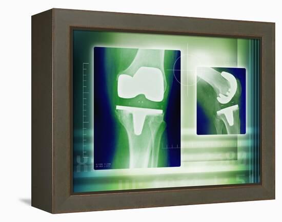 Knee Replacement, X-rays-Miriam Maslo-Framed Premier Image Canvas