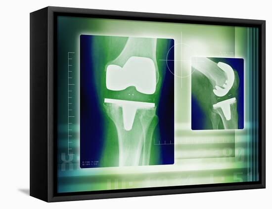 Knee Replacement, X-rays-Miriam Maslo-Framed Premier Image Canvas