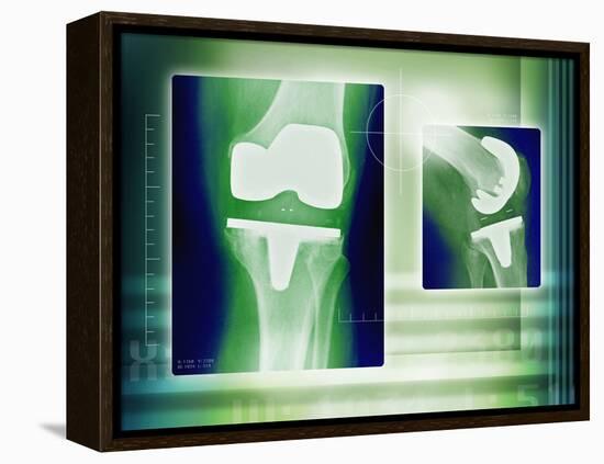 Knee Replacement, X-rays-Miriam Maslo-Framed Premier Image Canvas