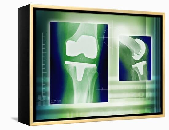 Knee Replacement, X-rays-Miriam Maslo-Framed Premier Image Canvas