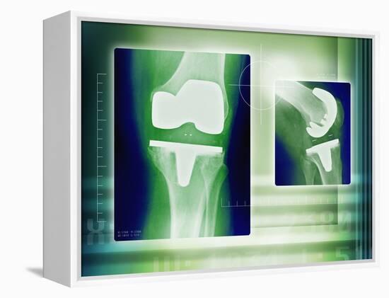 Knee Replacement, X-rays-Miriam Maslo-Framed Premier Image Canvas