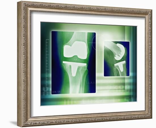 Knee Replacement, X-rays-Miriam Maslo-Framed Photographic Print