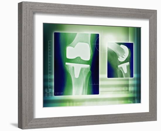 Knee Replacement, X-rays-Miriam Maslo-Framed Photographic Print
