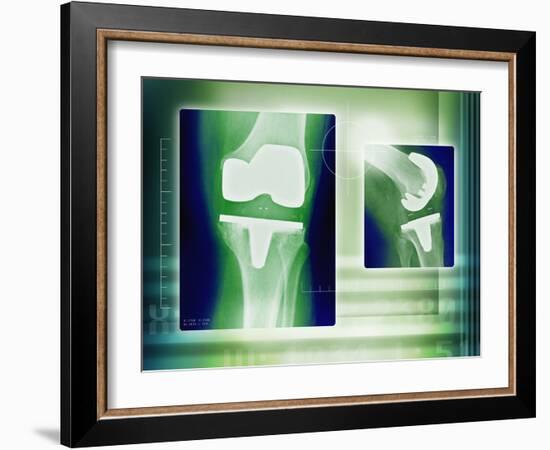 Knee Replacement, X-rays-Miriam Maslo-Framed Photographic Print