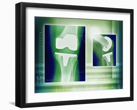 Knee Replacement, X-rays-Miriam Maslo-Framed Photographic Print