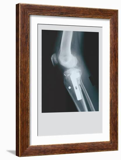 Knee Replacement-null-Framed Art Print