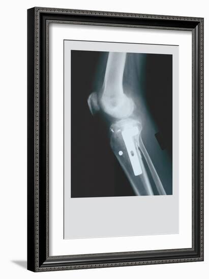 Knee Replacement-null-Framed Art Print