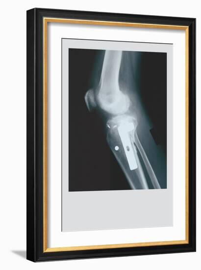 Knee Replacement-null-Framed Art Print