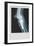 Knee Replacement-null-Framed Premium Giclee Print