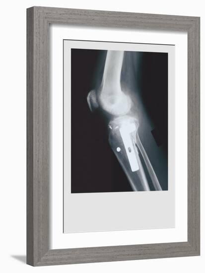 Knee Replacement-null-Framed Premium Giclee Print