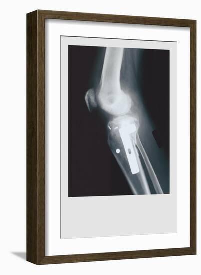 Knee Replacement-null-Framed Premium Giclee Print