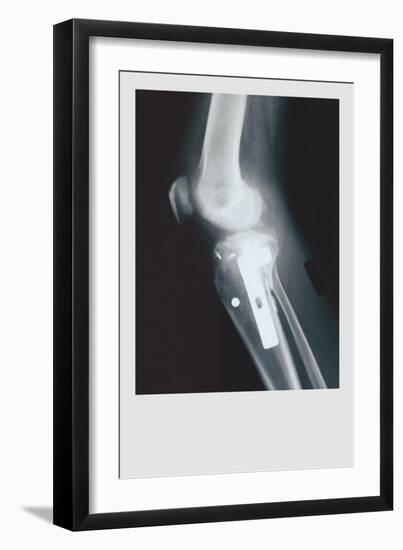 Knee Replacement-null-Framed Premium Giclee Print