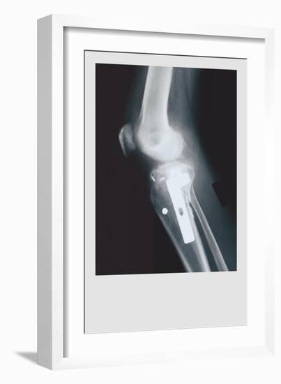 Knee Replacement-null-Framed Premium Giclee Print