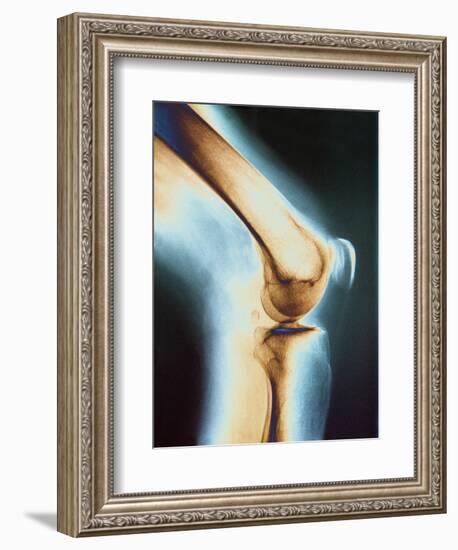 Knee X-ray-null-Framed Photographic Print