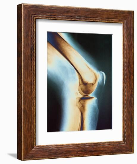 Knee X-ray-null-Framed Photographic Print