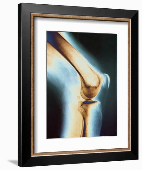 Knee X-ray-null-Framed Photographic Print