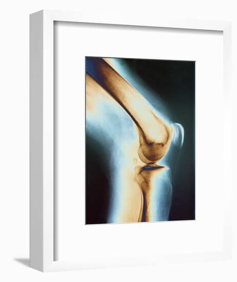 Knee X-ray-null-Framed Photographic Print