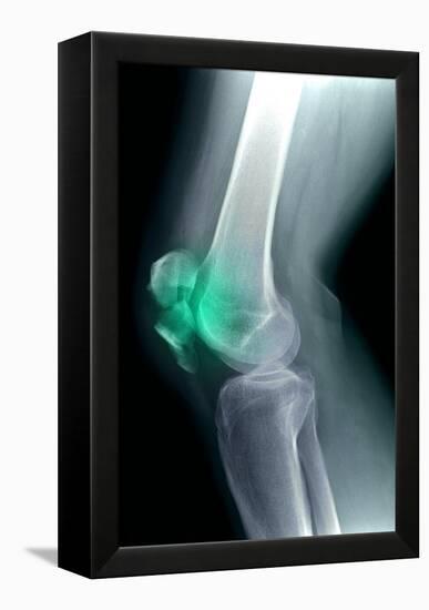Kneecap Fracture, X-ray-Du Cane Medical-Framed Premier Image Canvas
