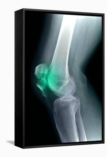 Kneecap Fracture, X-ray-Du Cane Medical-Framed Premier Image Canvas