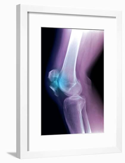 Kneecap Fracture, X-ray-Du Cane Medical-Framed Photographic Print