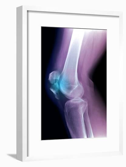 Kneecap Fracture, X-ray-Du Cane Medical-Framed Photographic Print