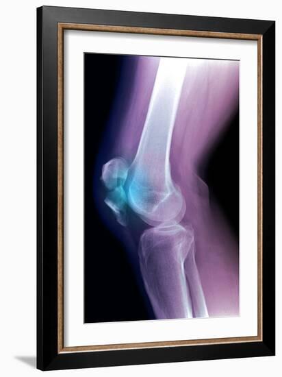 Kneecap Fracture, X-ray-Du Cane Medical-Framed Photographic Print