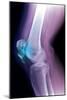 Kneecap Fracture, X-ray-Du Cane Medical-Mounted Photographic Print