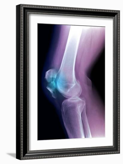 Kneecap Fracture, X-ray-Du Cane Medical-Framed Photographic Print