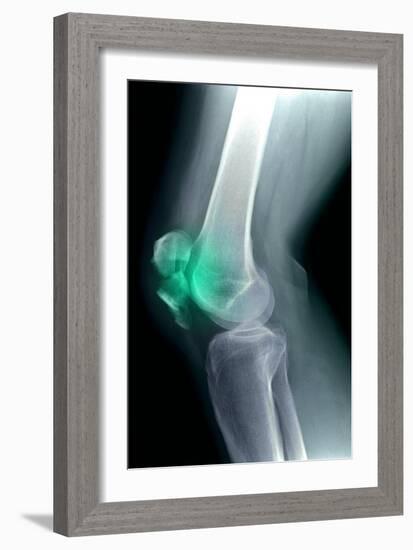 Kneecap Fracture, X-ray-Du Cane Medical-Framed Photographic Print