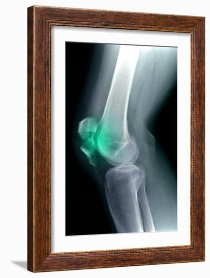 Kneecap Fracture, X-ray-Du Cane Medical-Framed Photographic Print