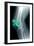 Kneecap Fracture, X-ray-Du Cane Medical-Framed Photographic Print