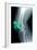 Kneecap Fracture, X-ray-Du Cane Medical-Framed Photographic Print