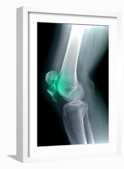 Kneecap Fracture, X-ray-Du Cane Medical-Framed Photographic Print