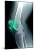 Kneecap Fracture, X-ray-Du Cane Medical-Mounted Photographic Print