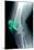 Kneecap Fracture, X-ray-Du Cane Medical-Mounted Photographic Print