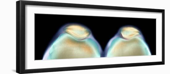 Kneecaps, X-ray-Science Photo Library-Framed Photographic Print