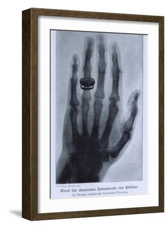 'Konrad Roentgen's X-Ray of the Hand of Showing Bones and the Ring, 1895'  Art Print | Art.com