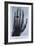 Konrad Roentgen's X-Ray of the Hand of Showing Bones and the Ring, 1895-null-Framed Art Print