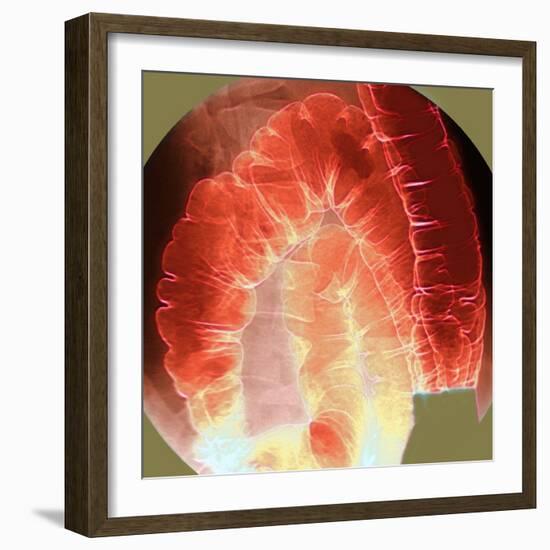 Large Intestine, X-ray-Du Cane Medical-Framed Premium Photographic Print