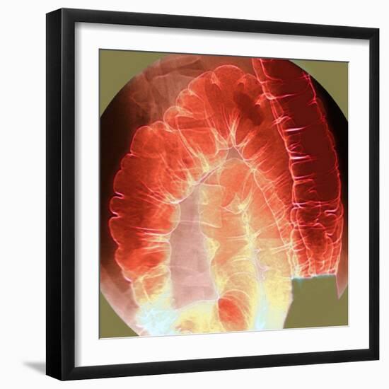Large Intestine, X-ray-Du Cane Medical-Framed Premium Photographic Print