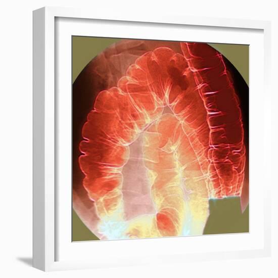 Large Intestine, X-ray-Du Cane Medical-Framed Premium Photographic Print