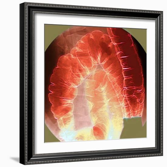 Large Intestine, X-ray-Du Cane Medical-Framed Premium Photographic Print