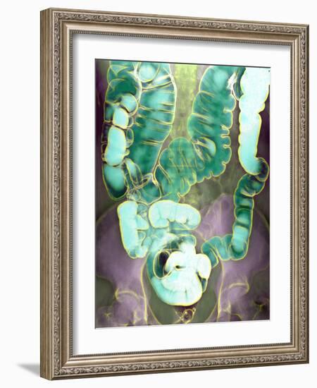 Large Intestine, X-ray-Du Cane Medical-Framed Photographic Print